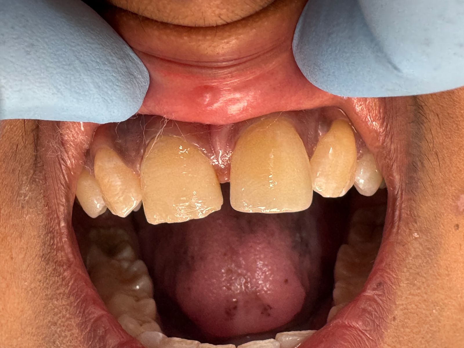 Aesthetic Space Closure before treatment